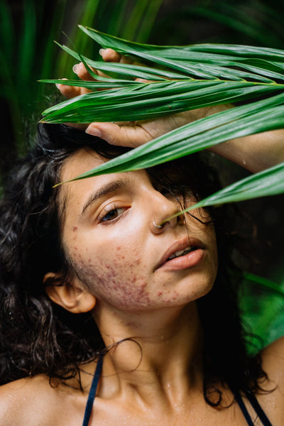 Acne Causes, Reasons and Standard Remedies